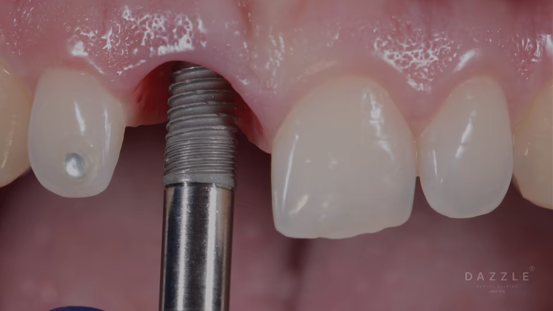 Single-Day Implants for Complex Cases: How Same-Day Teeth Are Possible When Alveolar Bone Is Absent