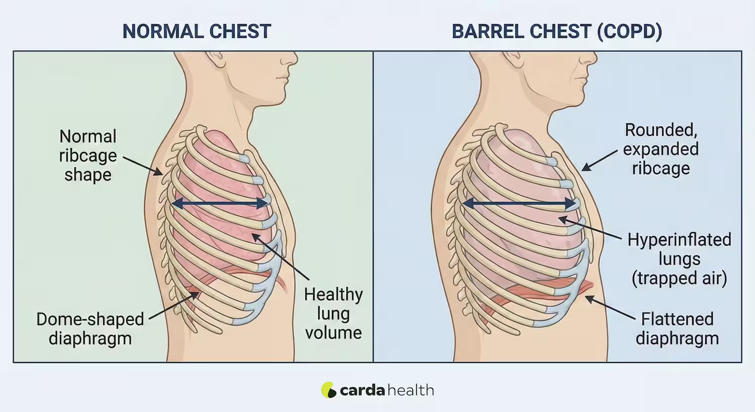 Comparison of normal chest and barrel chest in COPD with rib and lung changes.