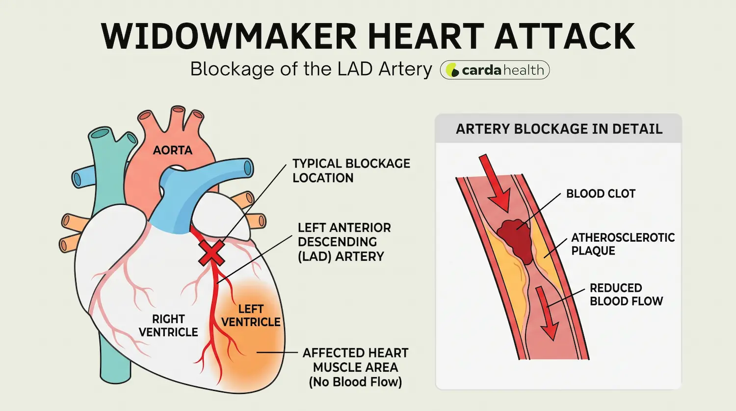 Diagram of the heart showing the LAD artery and where blockage occurs during a widowmaker heart attack