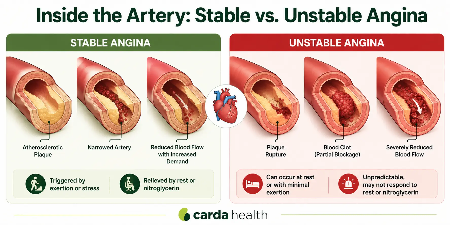 Stable vs unstable angina diagram showing artery blockage and blood flow differences