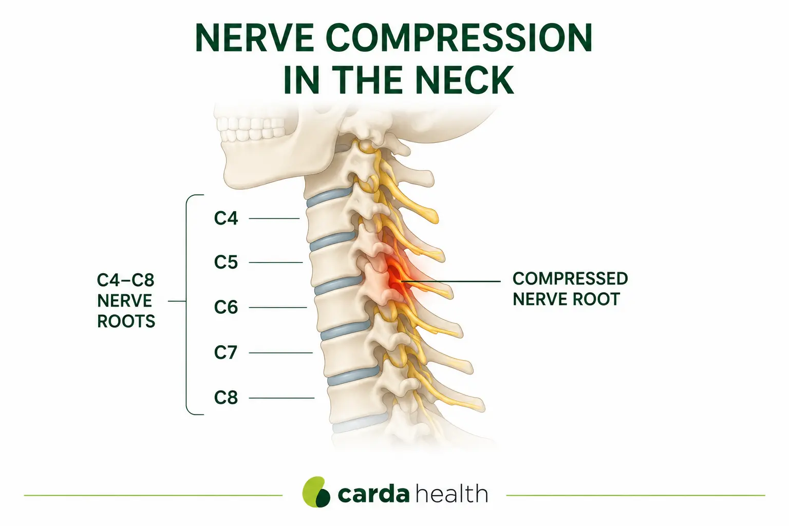 Neck nerve compression diagram showing compressed cervical nerve roots from C4 to C8