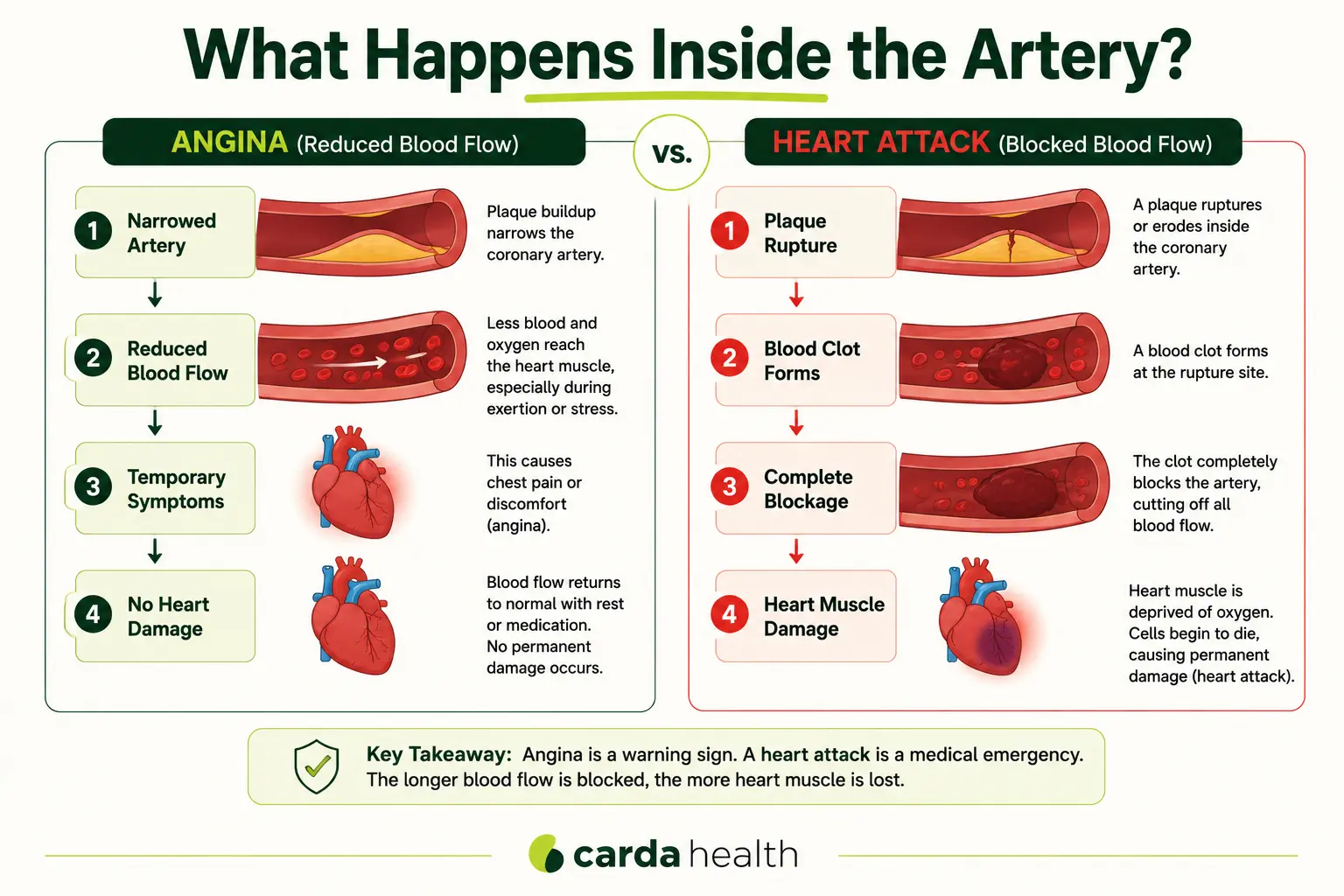 Angina vs heart attack artery diagram showing reduced blood flow versus complete blockage