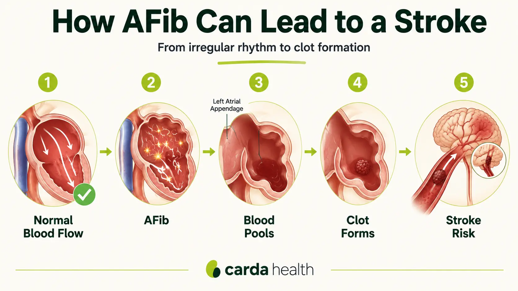 How atrial fibrillation lets blood pool in the heart, form clots, and raise stroke risk.
