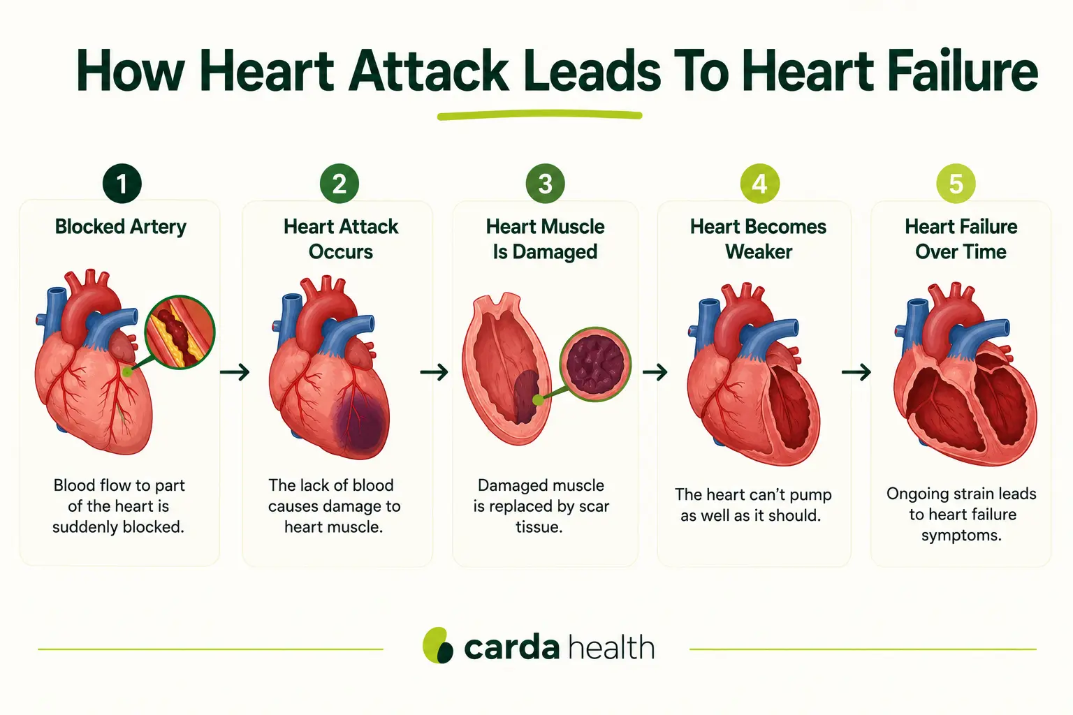 Flow diagram of how a heart attack can lead to heart failure.