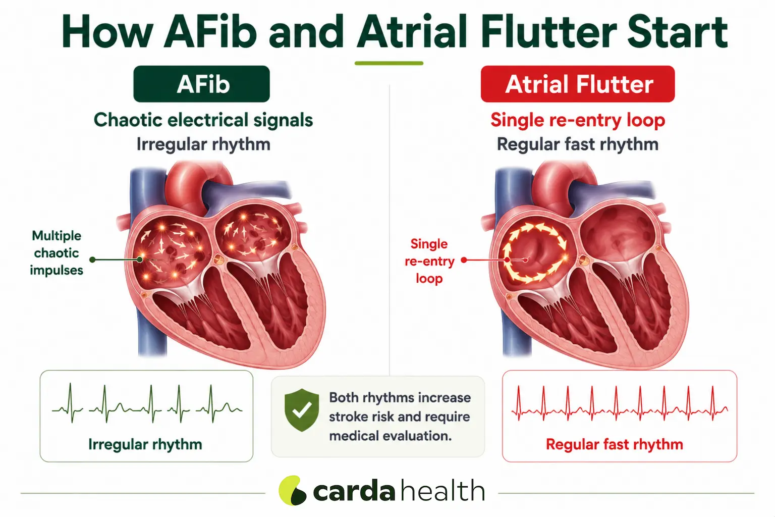 Difference between the chaotic rhythm of AFib and the organized racetrack loop of atrial flutter.