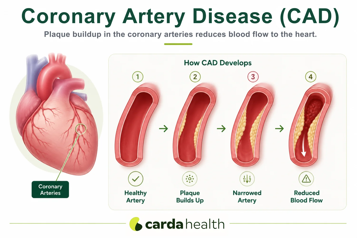 How plaque builds up and reduces blood flow to the heart in coronary artery disease.