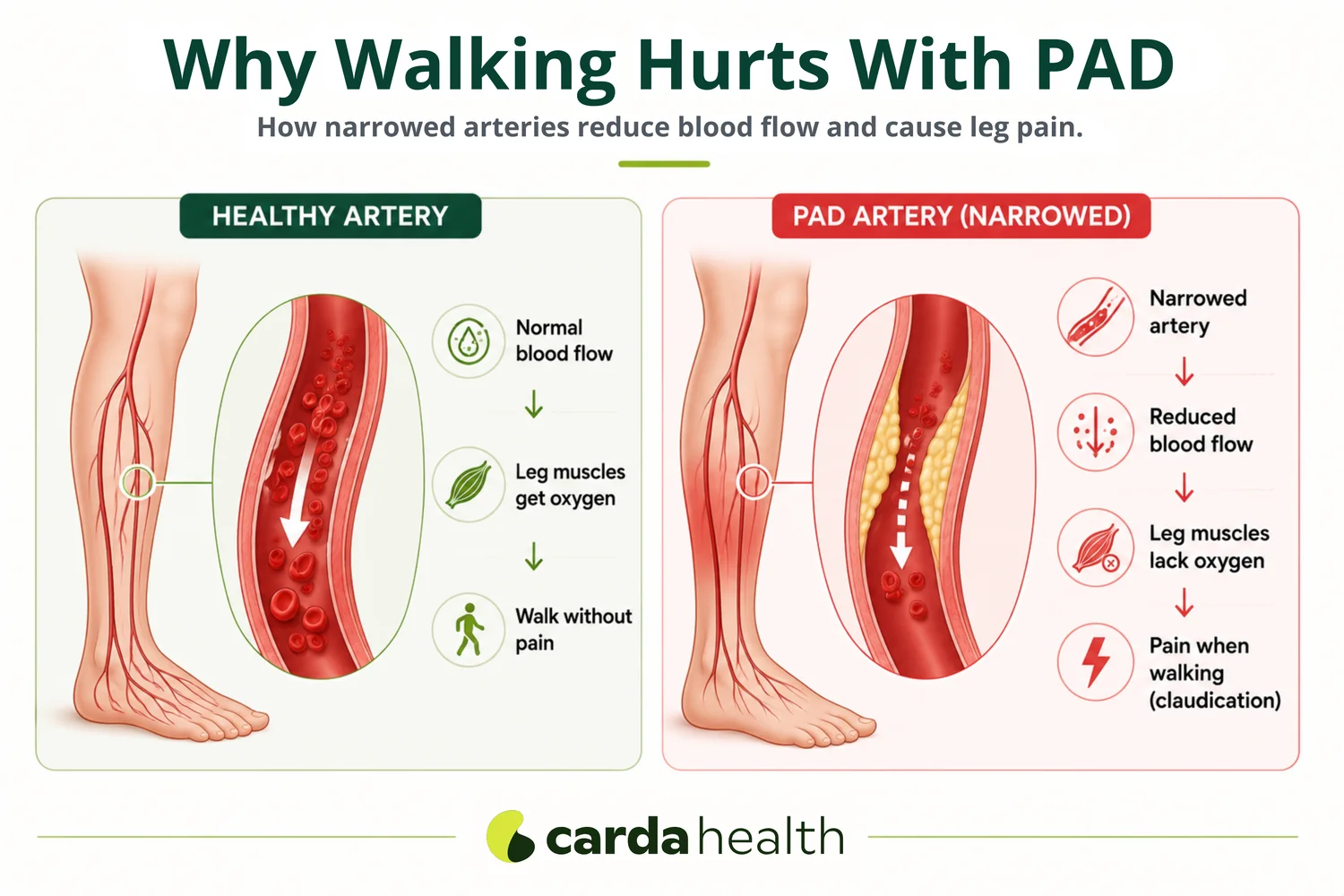 How narrowed leg arteries in PAD reduce blood flow and cause claudication pain when walking.