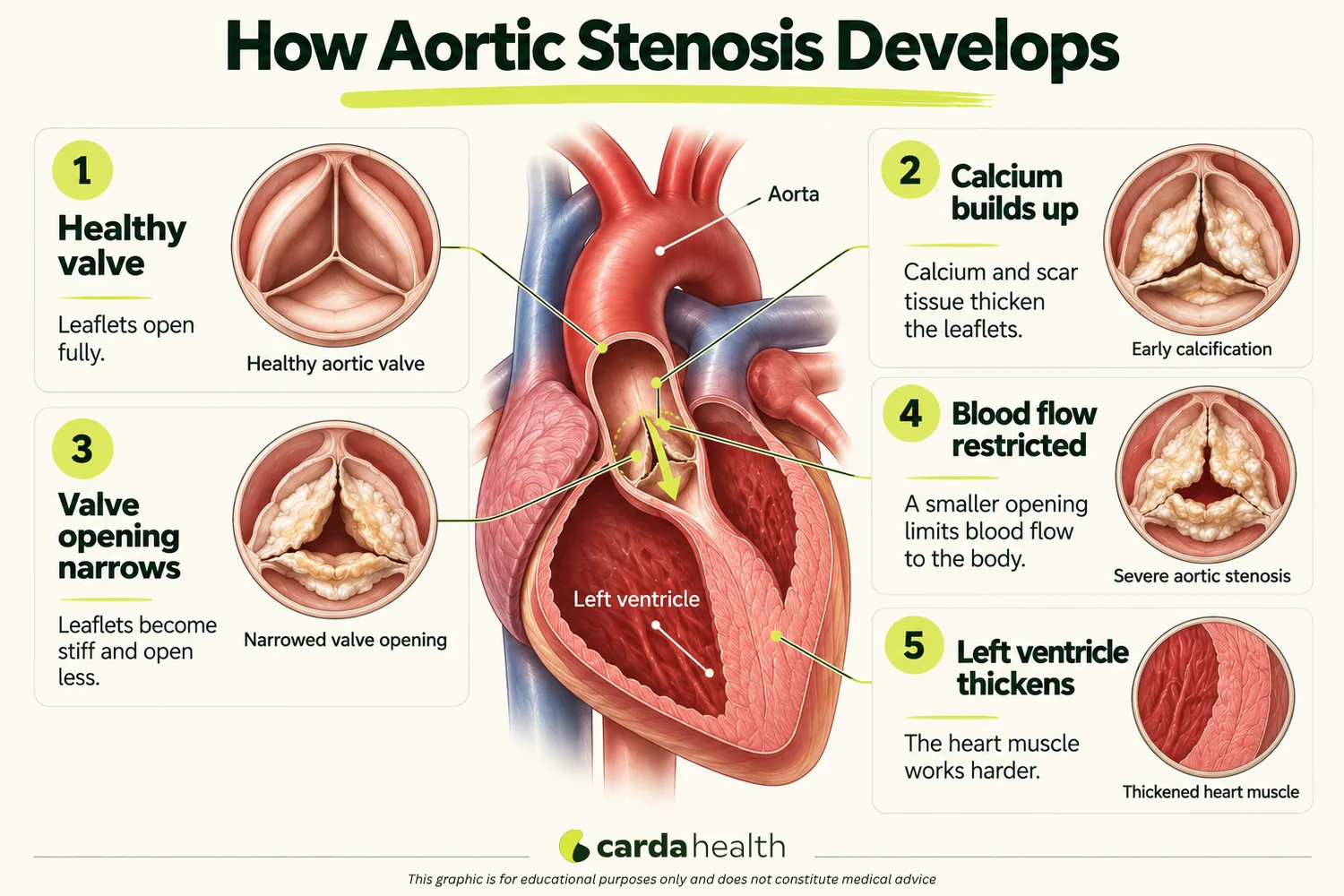 Cross-section educational diagram of the aortic valve showing a healthy three-leaflet valve alongside progressive calcification and thickening, with the left ventricle wall thickening in response to the obstruction.
