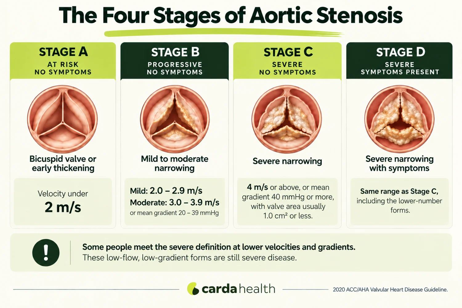 Educational graphic of the four ACC/AHA stages of aortic stenosis, A to D, showing how the valve narrows at each stage alongside the echo velocity and gradient ranges, with a note that low-flow, low-gradient forms can be severe at lower readings.