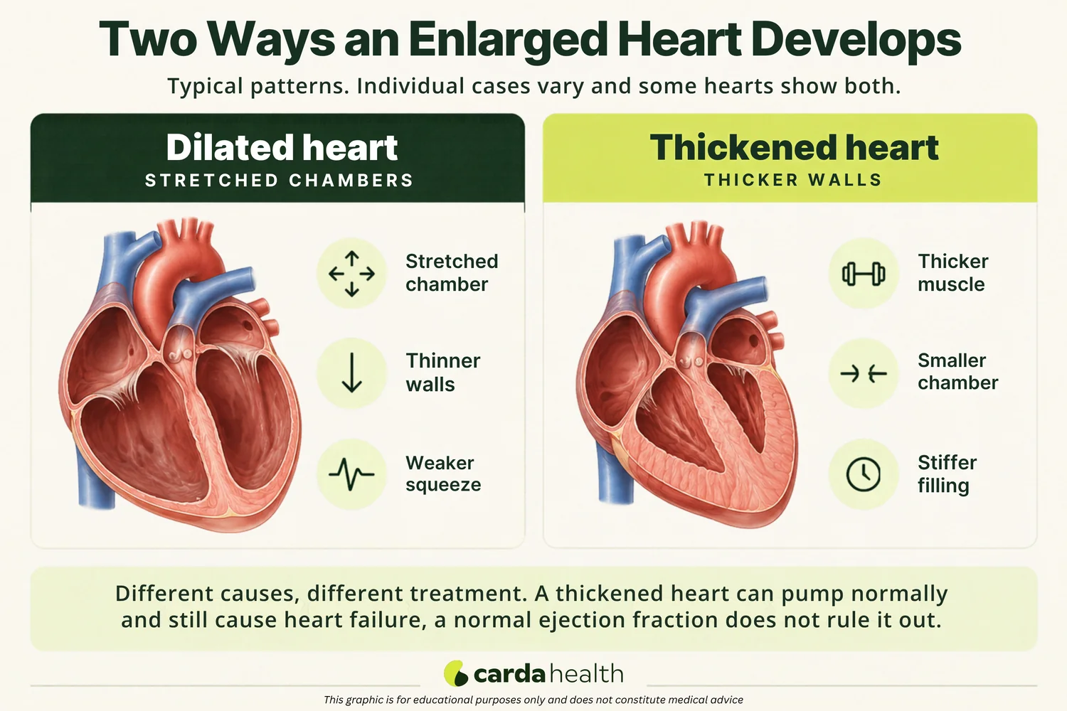 Medical illustration comparing a dilated heart with enlarged chambers and a thickened heart with thicker muscle walls, showing the two main patterns of cardiomegaly.
