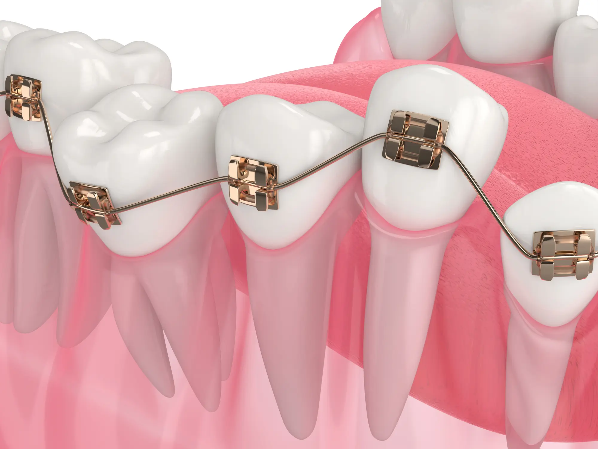 What to Do if Braces Break: Handling Orthodontic Emergencies After School Starts