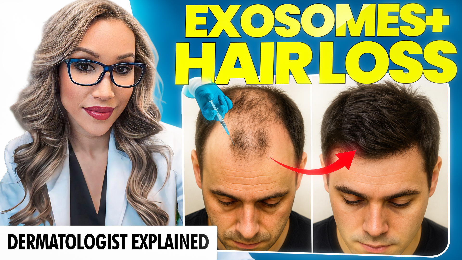 Exosomes for Hair Loss: Do They Really Work?