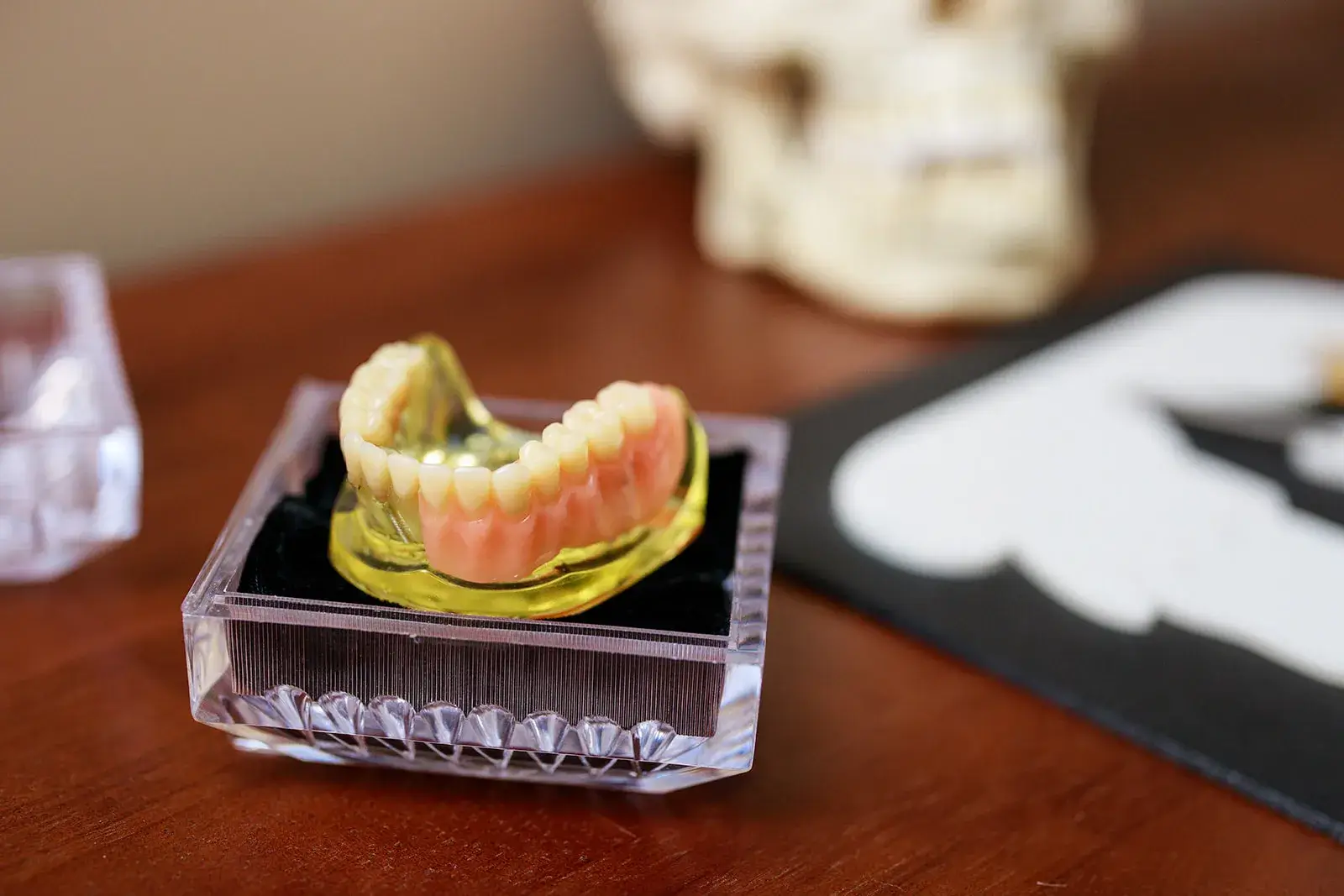 Dental implant overdenture model in a clear display box.
