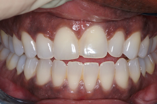 before and after treatment