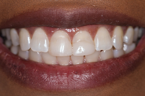 before and after treatment