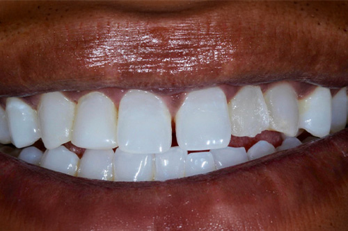 before and after treatment