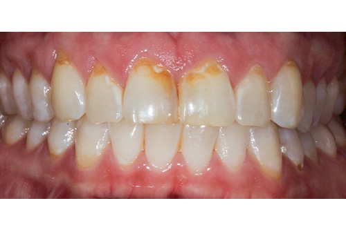 before and after treatment