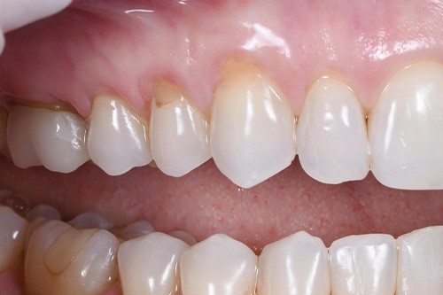 before and after treatment