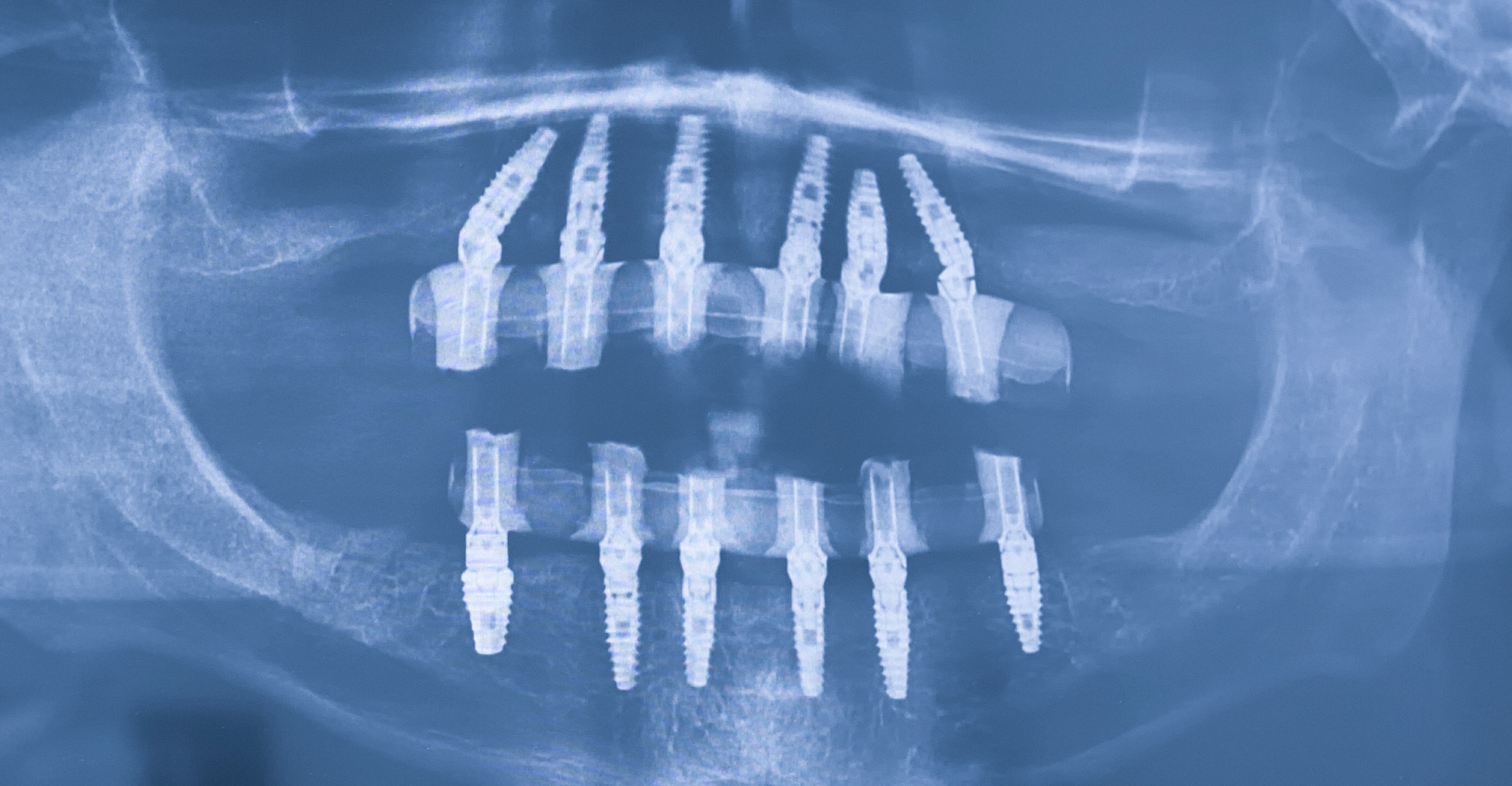 Dental implants representing Dr. Andrew Currie’s ABOI/ID Diplomate achievement