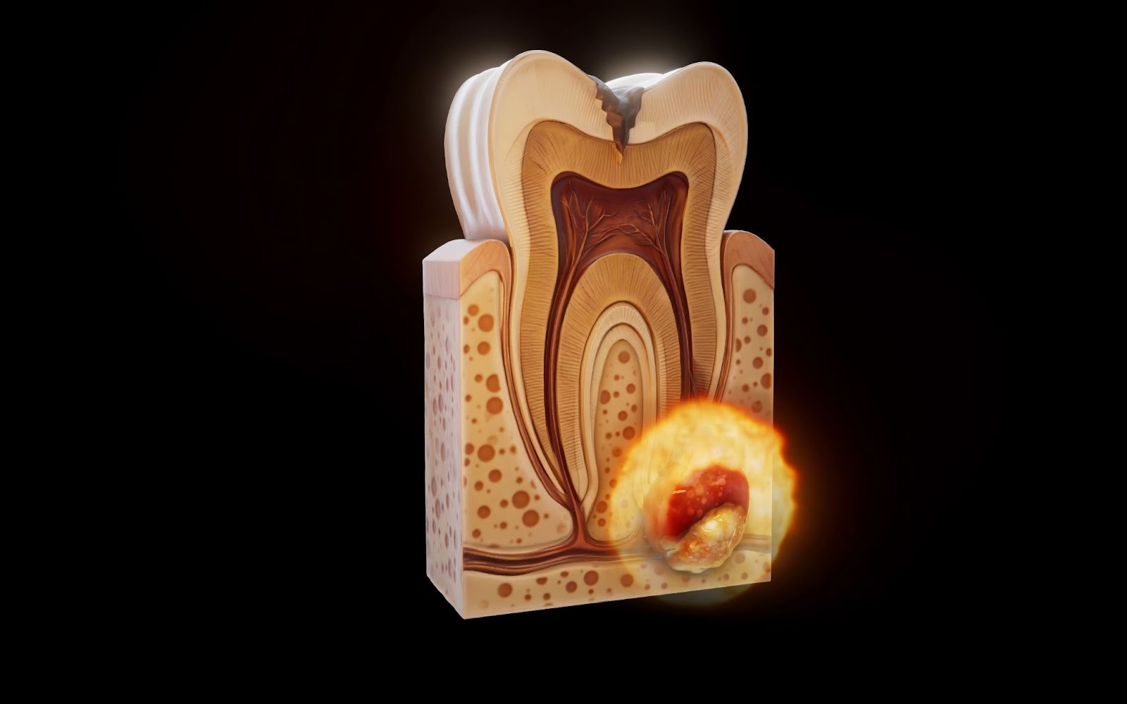 3D cross-section of a tooth showing a severe root infection and abscess.