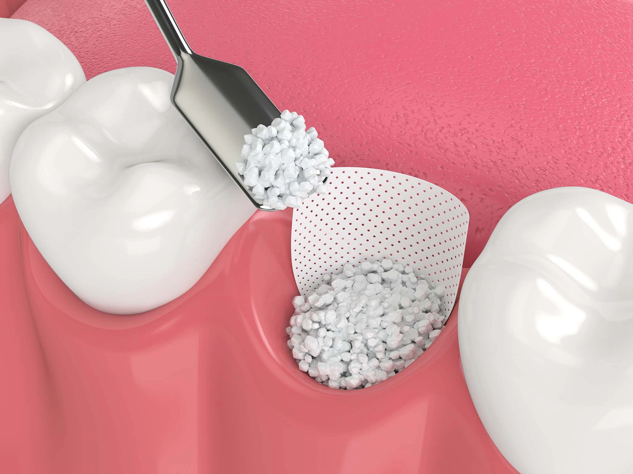 Medical illustration of a dental bone grafting procedure placing material into the jaw.