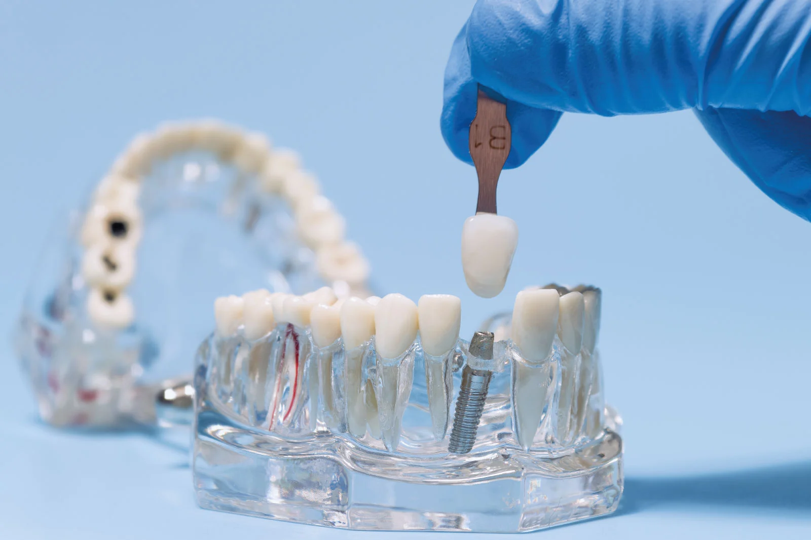 Dental implant model with a gloved hand placing a crown at Coastal Virginia Oral Surgery.
