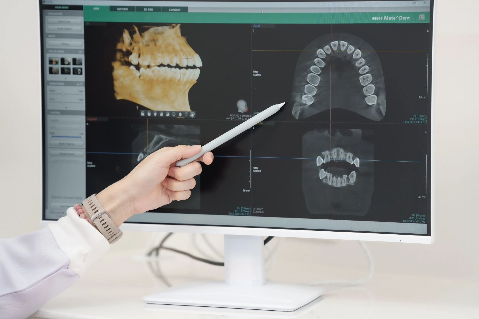 Surgeon pointing to 3D jaw scans on a monitor at Coastal Virginia Oral Surgery.