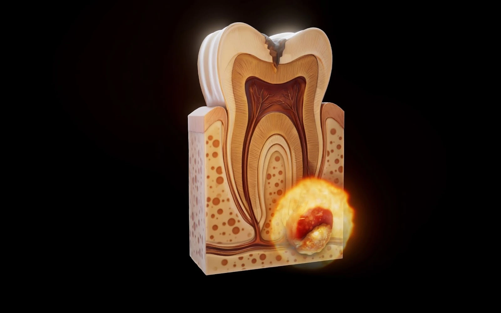 Diagram of a tooth cross-section showing a periapical abscess at the root.