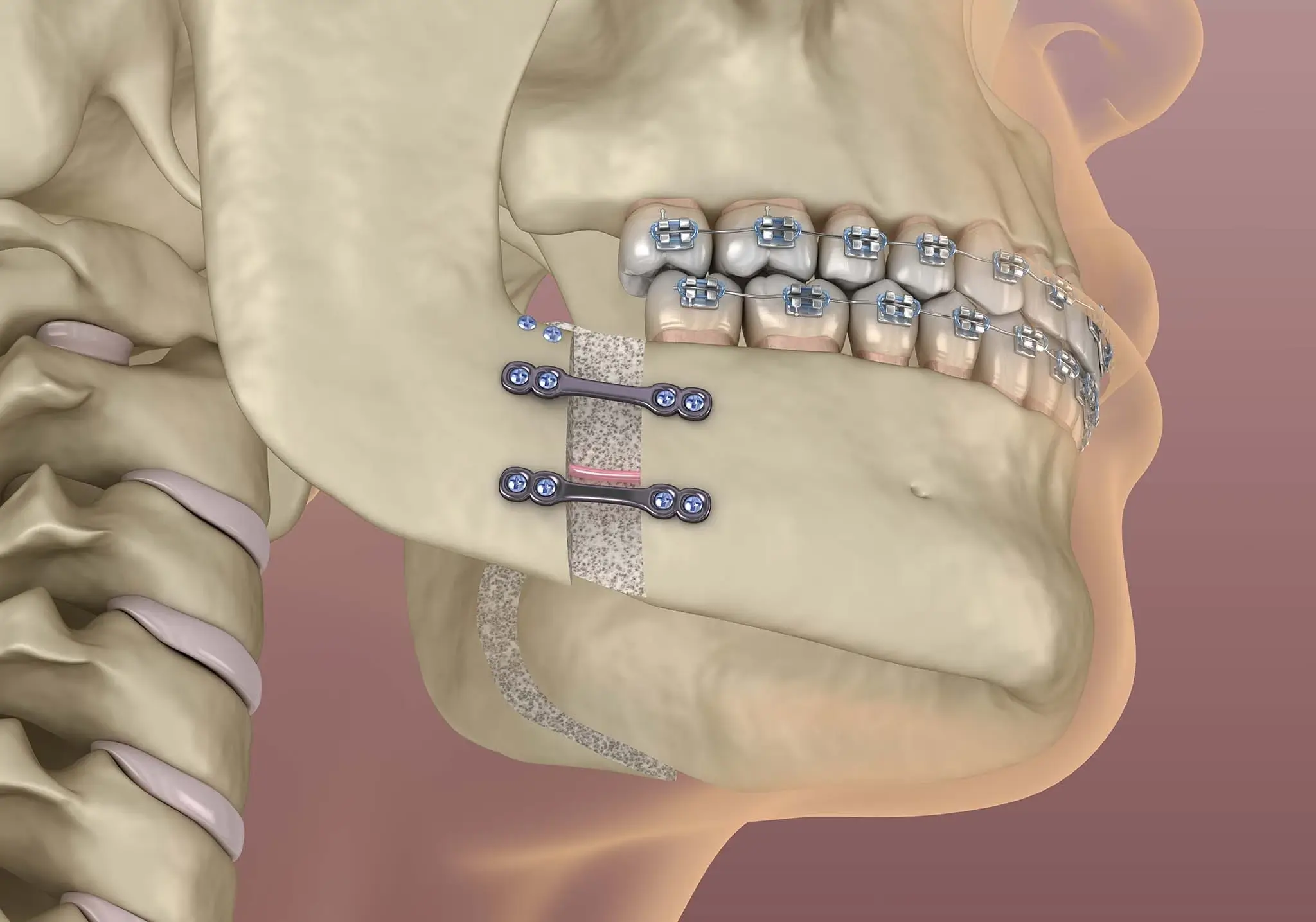 Diagram of corrective jaw surgery with surgical plates and braces.