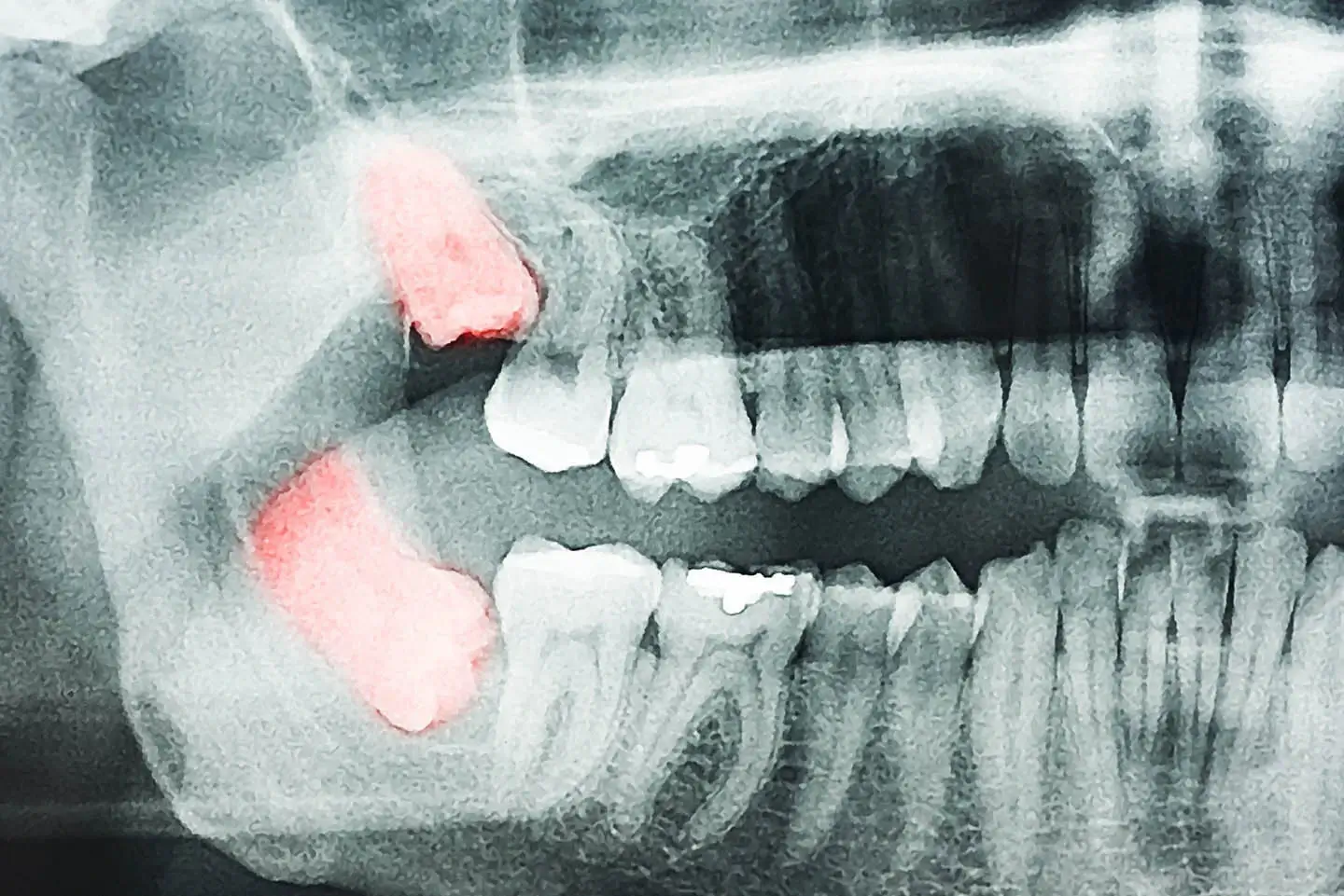 Dental X-ray highlighting two impacted wisdom teeth in the jaw.
