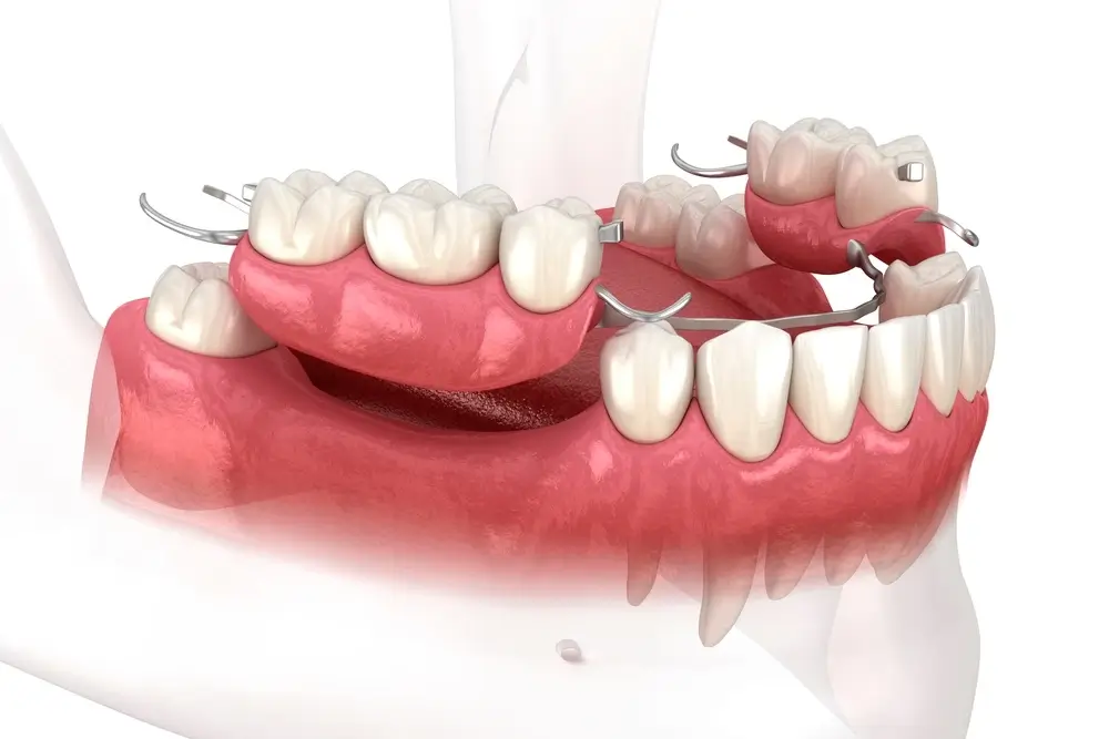 3D illustration of a removable partial denture fitted onto lower jaw teeth.