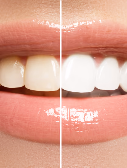Close-up of a person's mouth showing front teeth, split with a vertical line: left side with yellowed teeth and right side with bright white teeth illustrating teeth whitening.