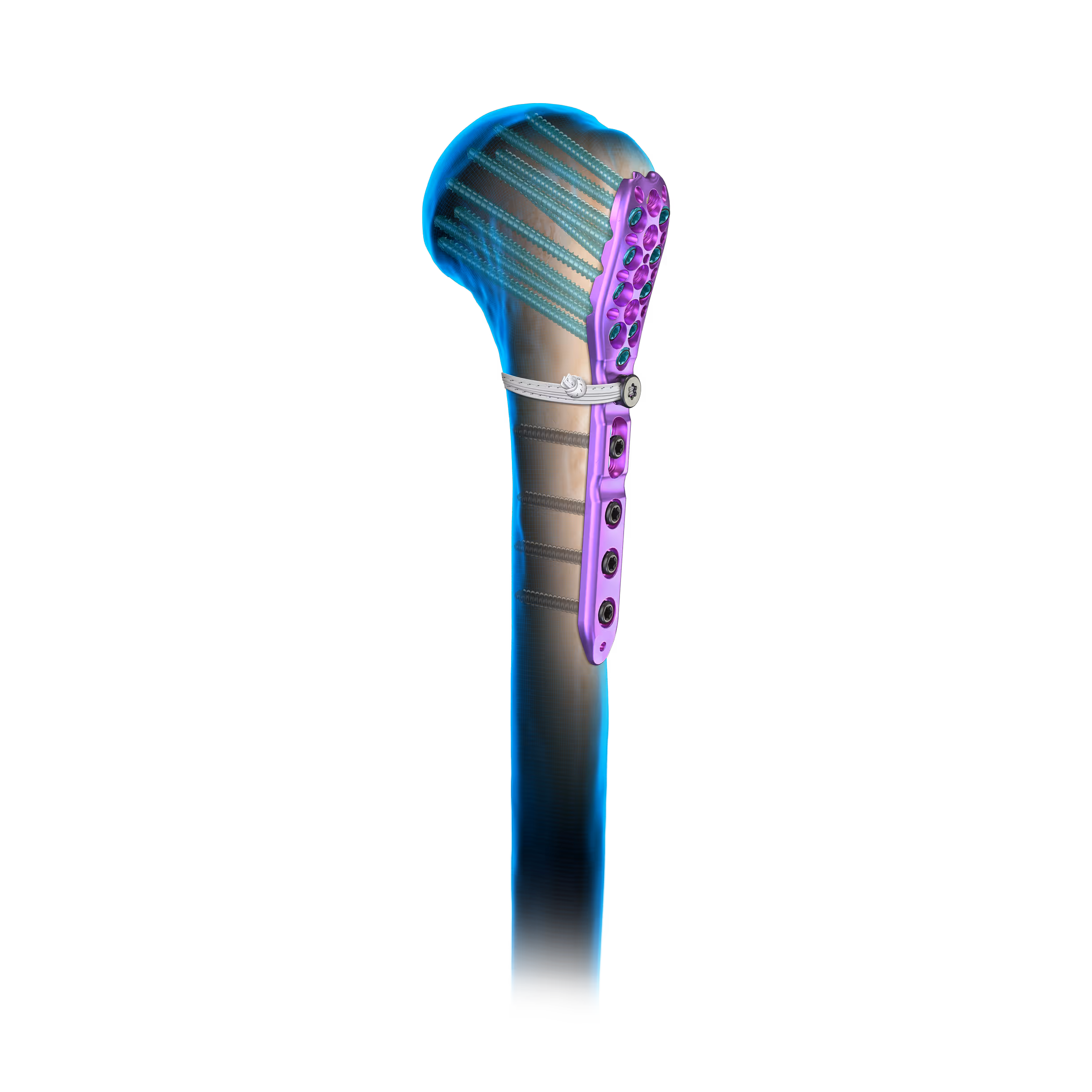 Purple titanium plate screwed into the humerus. The screws are visible in the transparent bone.