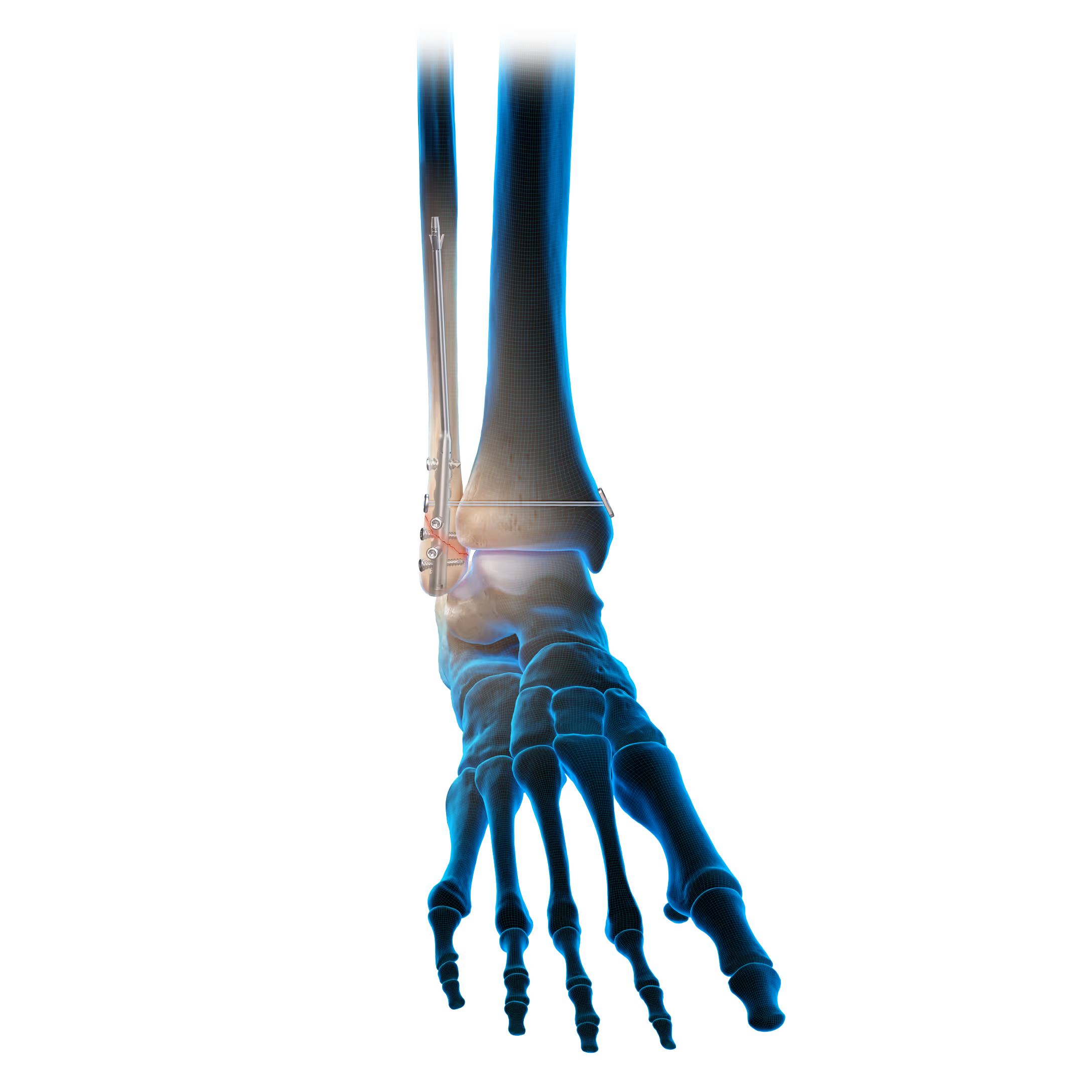 Metal implant and screws plus suture fixed in the ankle bone.