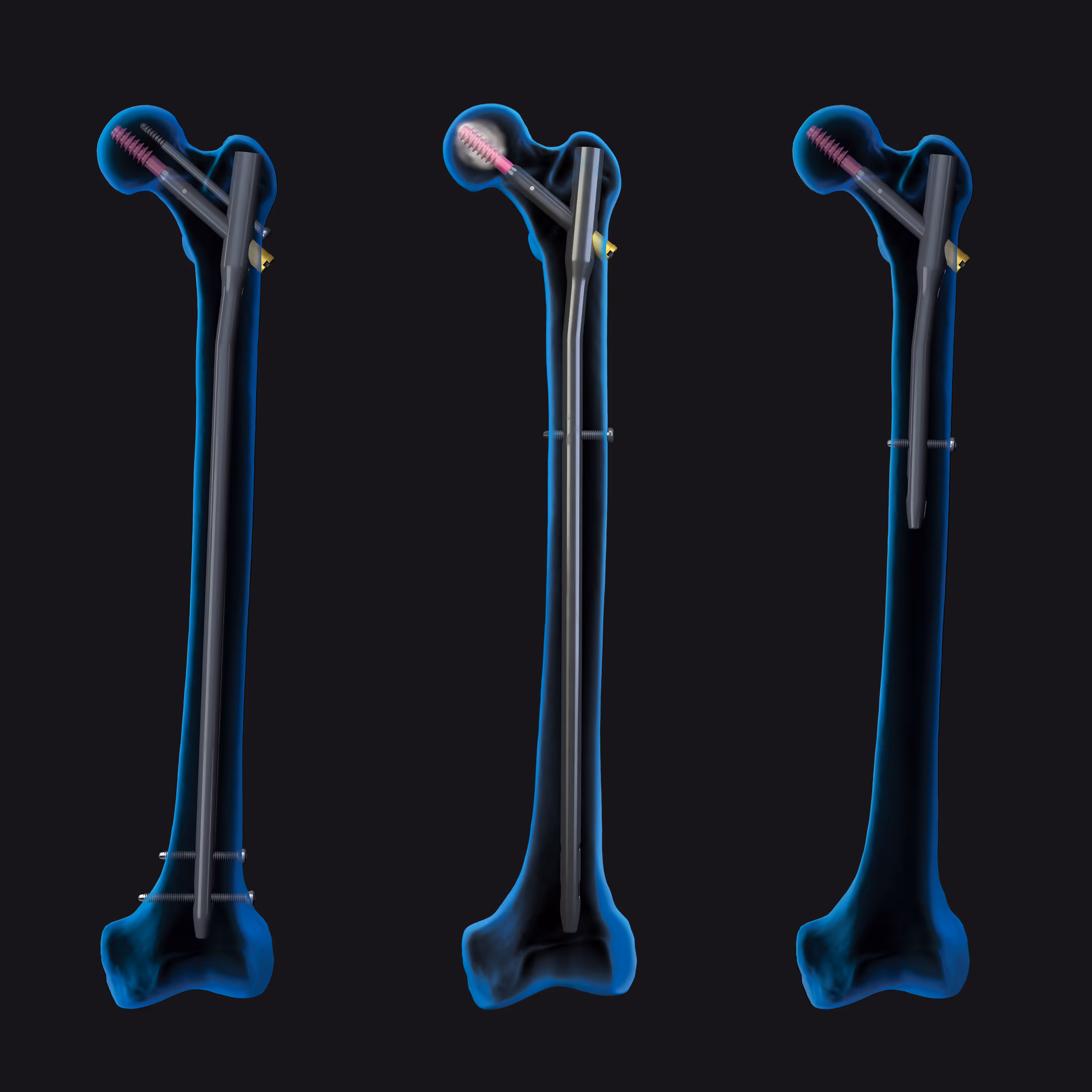 Three transparent femurs. The first two have a long trochanteric nail inserted in the bone. The last has a short trochanteric nail.