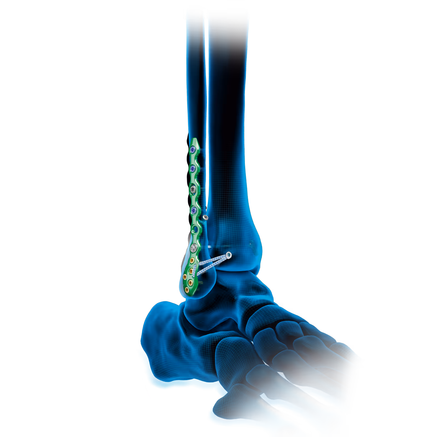 Plates screwed into ankle bone for fracture management.