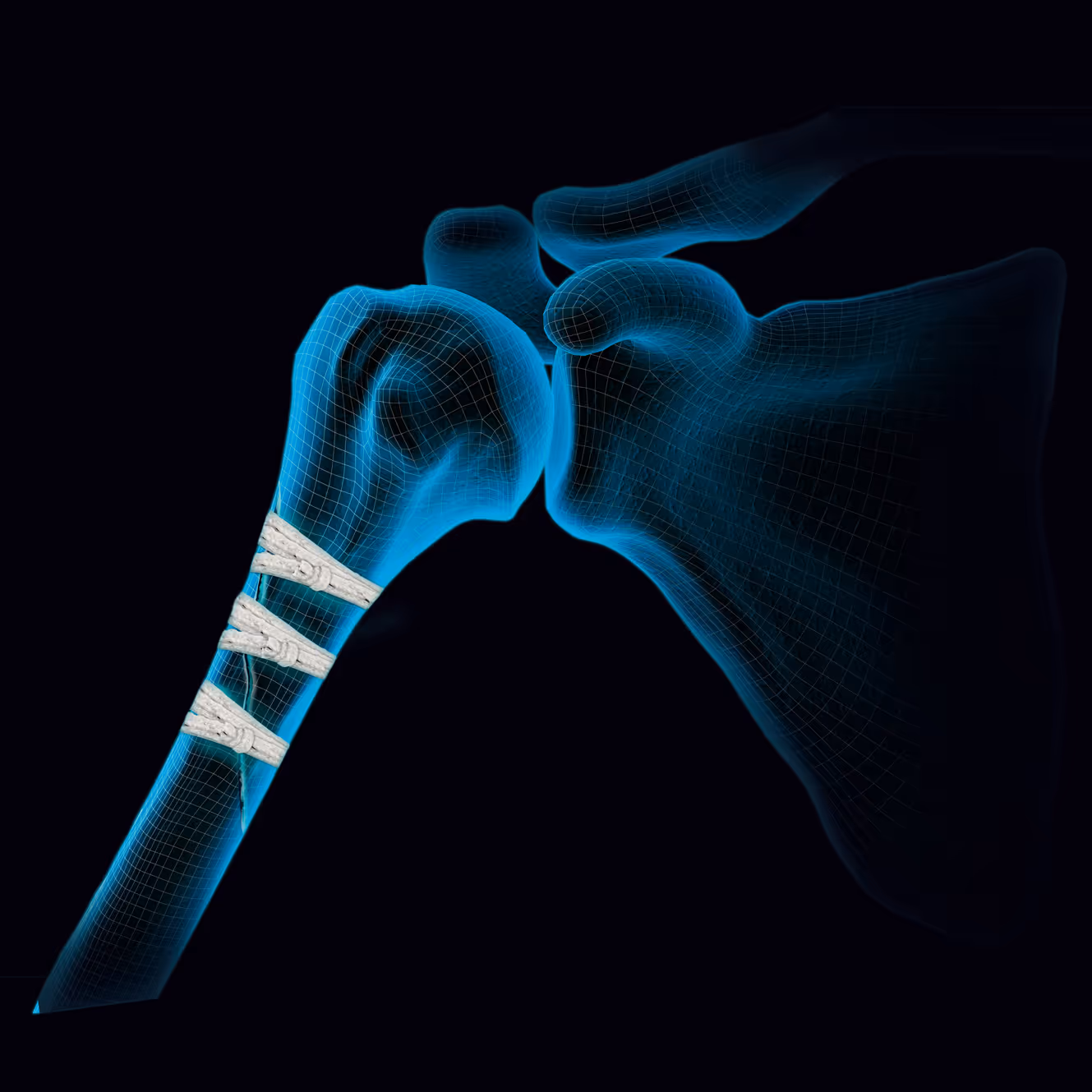 A suture is tied around a bone fracture.