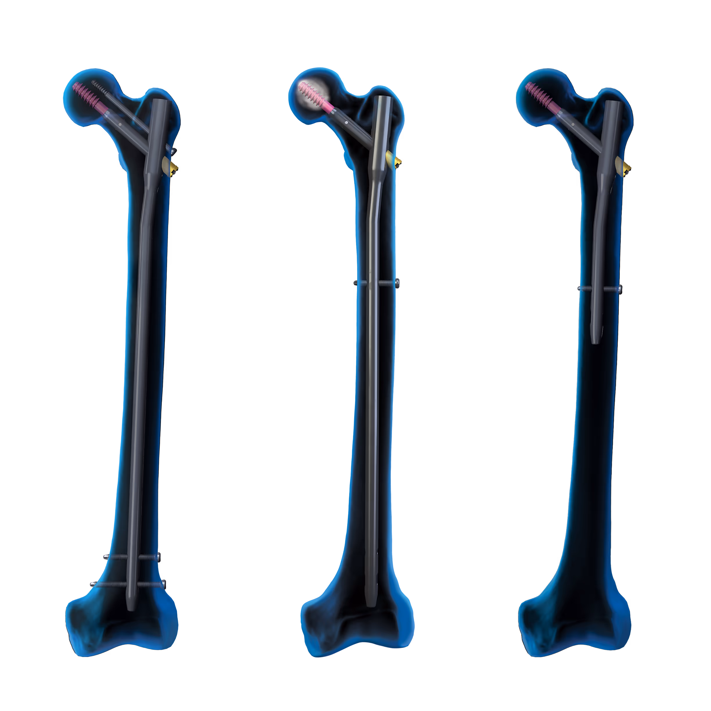Three transparent femurs. The first two have a long trochanteric nail inserted in the bone. The last has a short trochanteric nail.