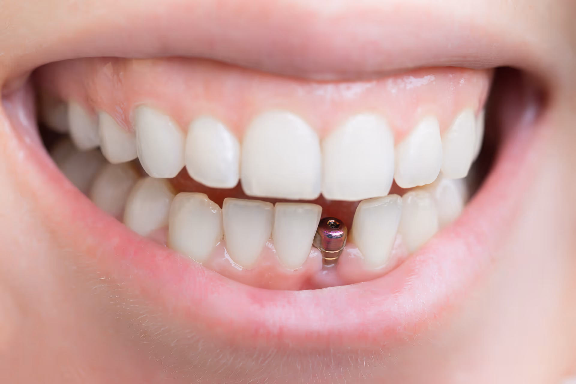 implant restoration in Greensboro