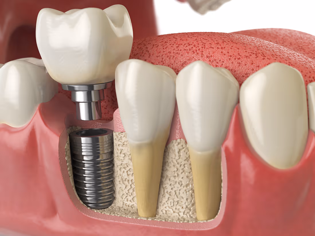 Greensboro, NC implant restoration