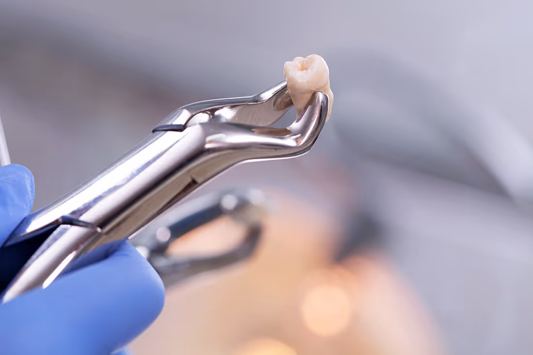 Tooth Extractions In Greensboro, NC