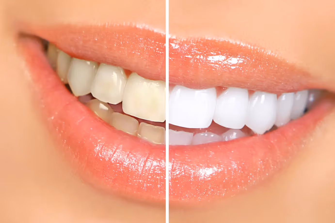 Greensboro Teeth Whitening