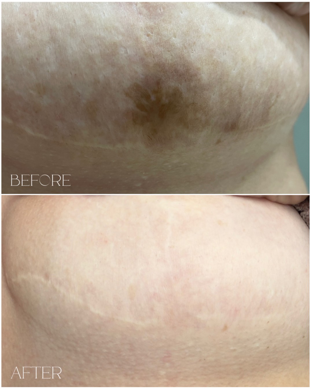 Scar camouflage permanent cosmetics Northern Virginia