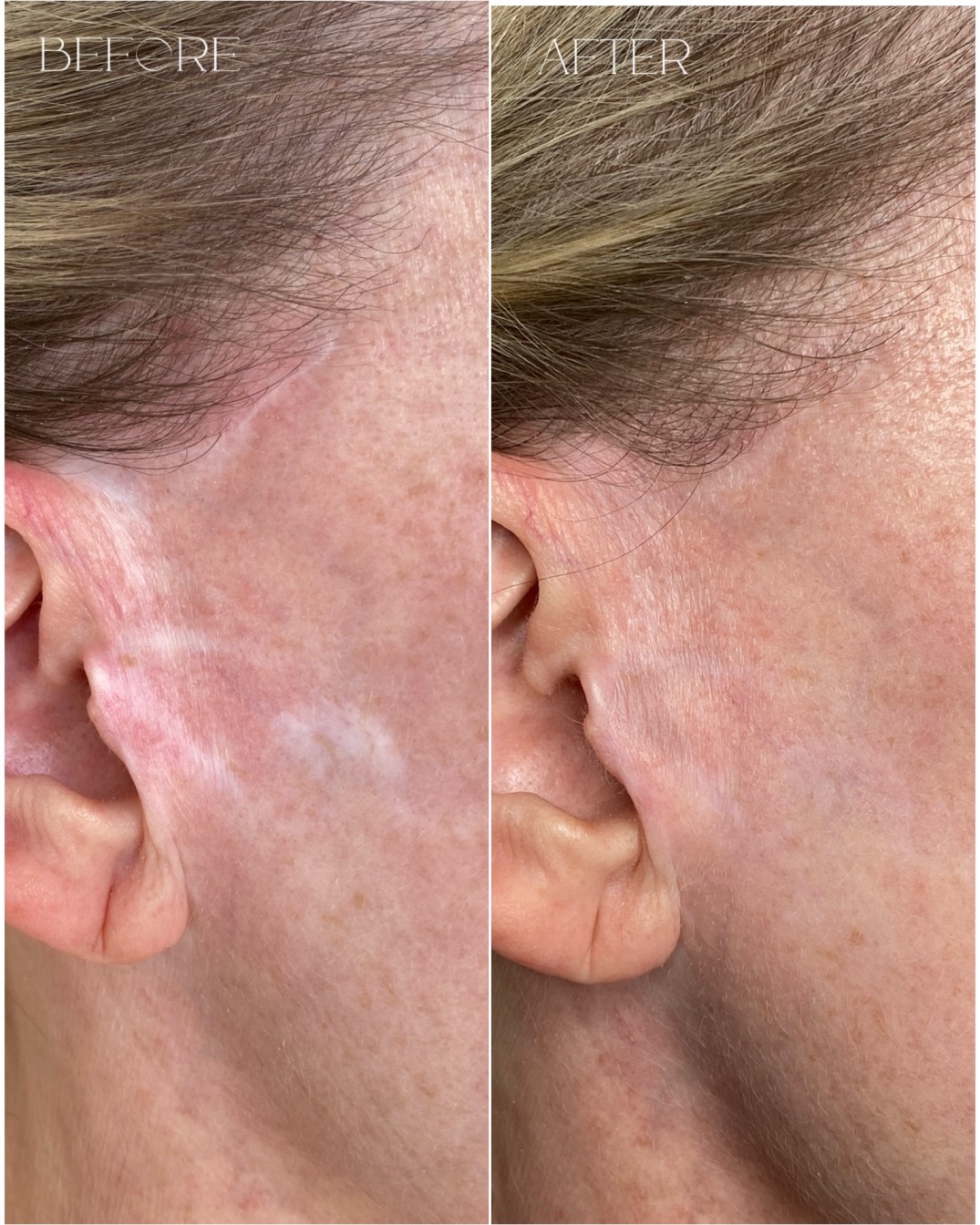 Skin camouflage permanent makeup Re:Pigment.Me Northern Virginia