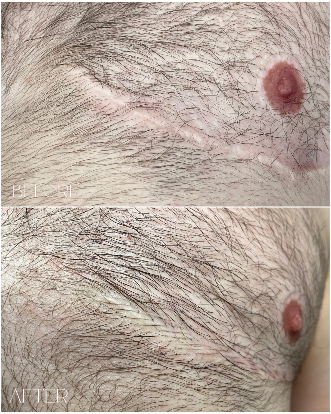 Stretch mark camouflage permanent makeup before and after Sterling VA