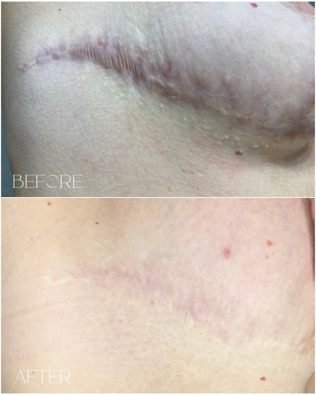Scar lightening and skin camouflage permanent makeup Re:Pigment.Me
