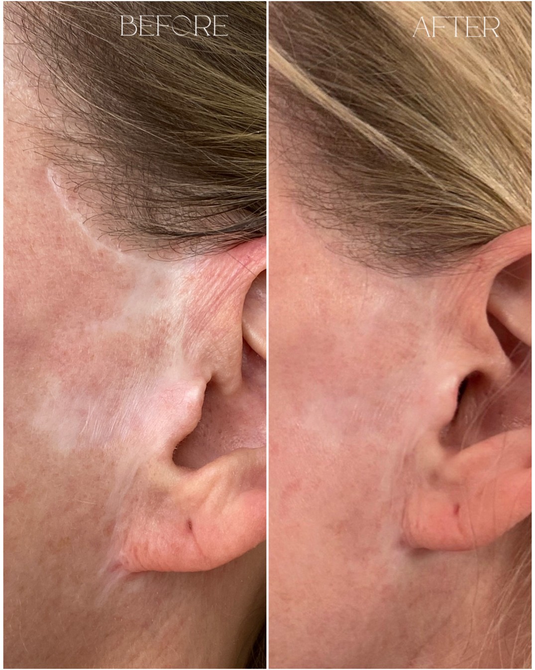 Scar camouflage permanent cosmetics Northern Virginia