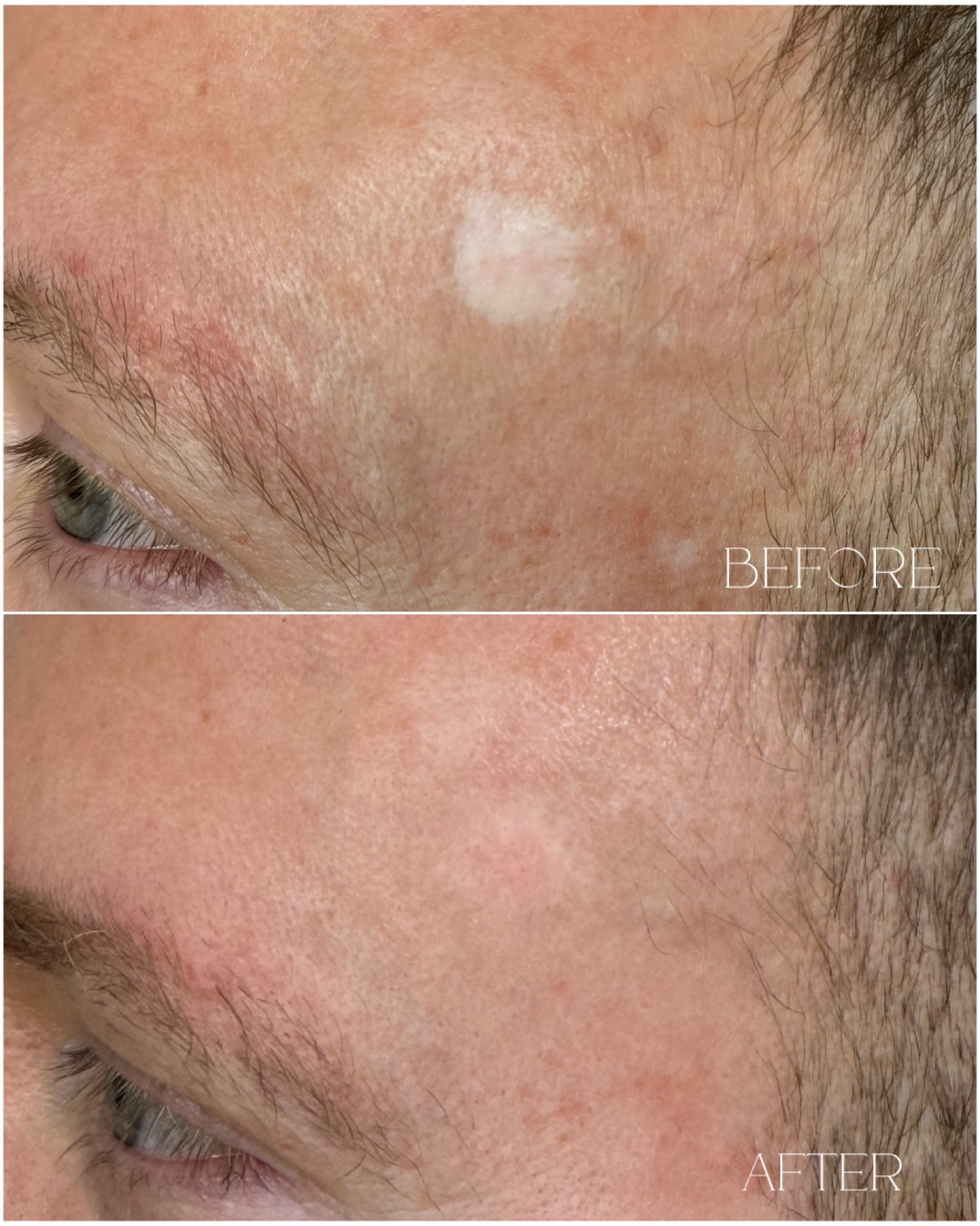 Skin tone scar camouflage permanent makeup Re:Pigment.Me