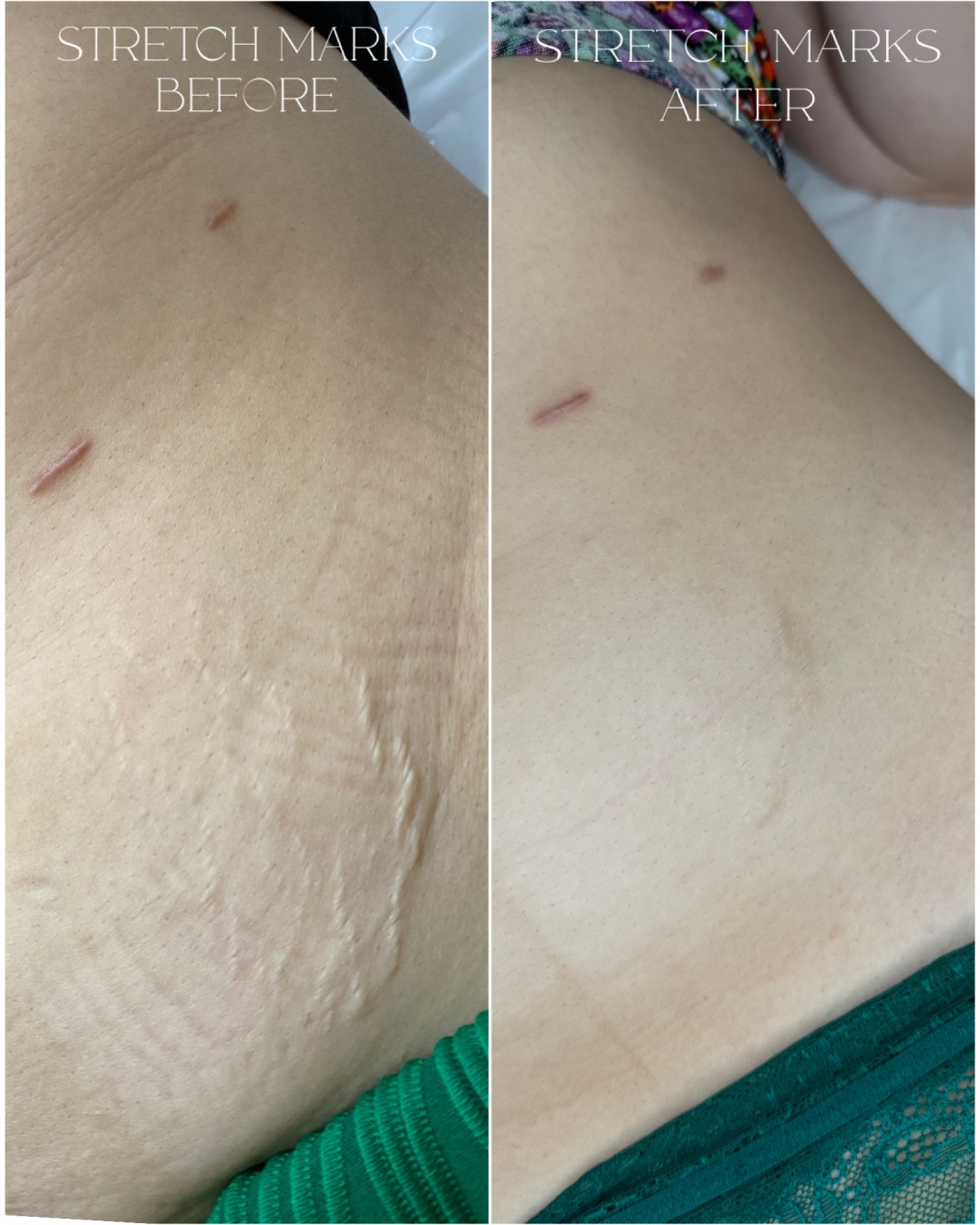 Scar lightening and skin camouflage permanent makeup Re:Pigment.Me