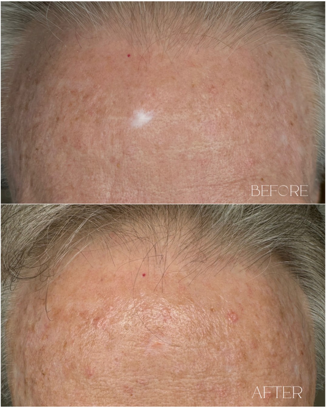 Skin camouflage permanent makeup Re:Pigment.Me Northern Virginia